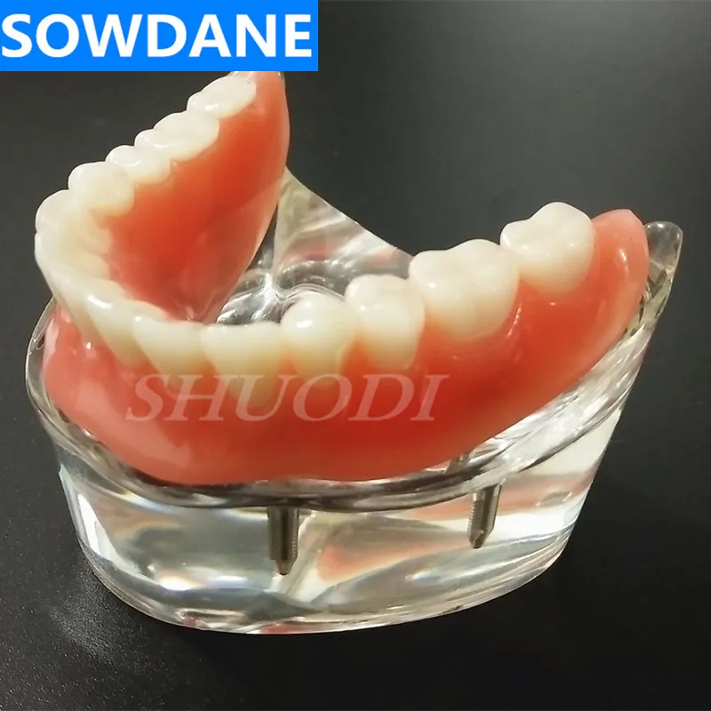 Dantų Overdenture Interjero keičia apatinio žandikaulio Apatinio su 4 Implantų Atkurti Dantys Studijų Mokyti Modelis