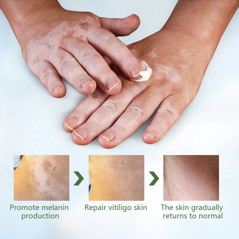 Sumifun 5vnt Vitiligo Treament Kremas Antibakterinis Psoriazė Lokalizuota Tepalas Mycosis Leukoplakia Gipso Balta Dėmė Balta