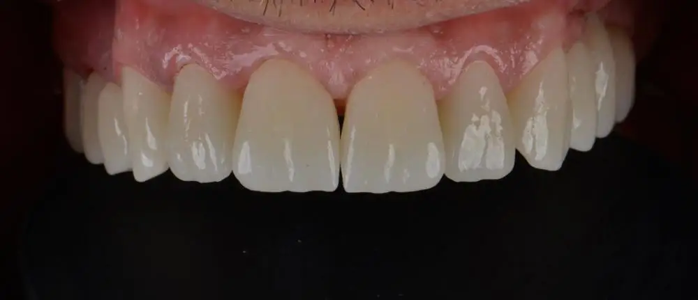 ST+ML 9818mm daugiasluoksnės, cirkonio dantų blokai wieland atidaryti cad cam cirkonis OD98 super vaiskumą